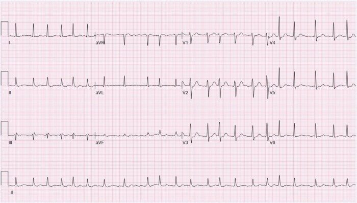 What is af in medical terms