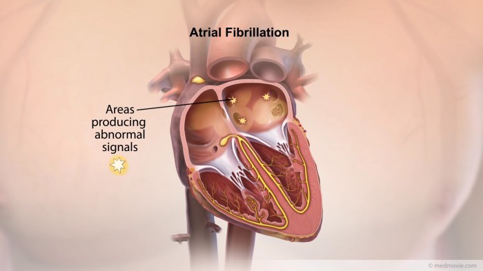 Atrial fibrillation flutter atriale medicali cardiaci diagrammi ventricular afib ecg fibrillazione cardiology normale ventricolare depolarization