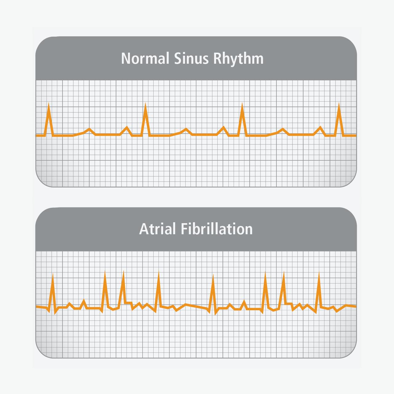 What is af in medical terms